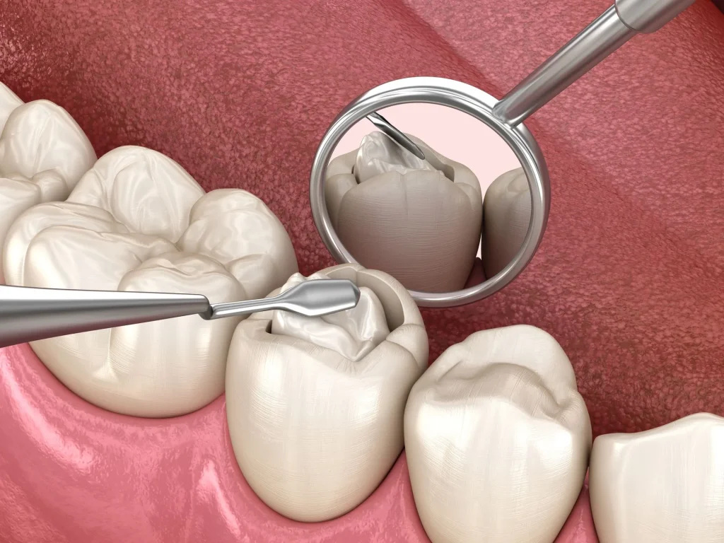Dental Fillings: Types and Which One to Choose