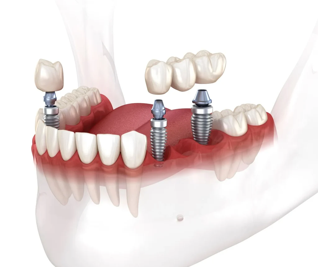 Benefits of Dental Implants over Dentures
