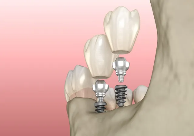 All About Dental Implant Materials: Which One is Right for You?