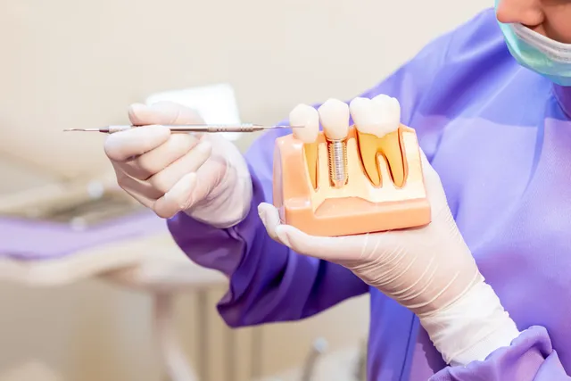 The Science Behind Dental Implants: How They Fuse with Your Jawbone