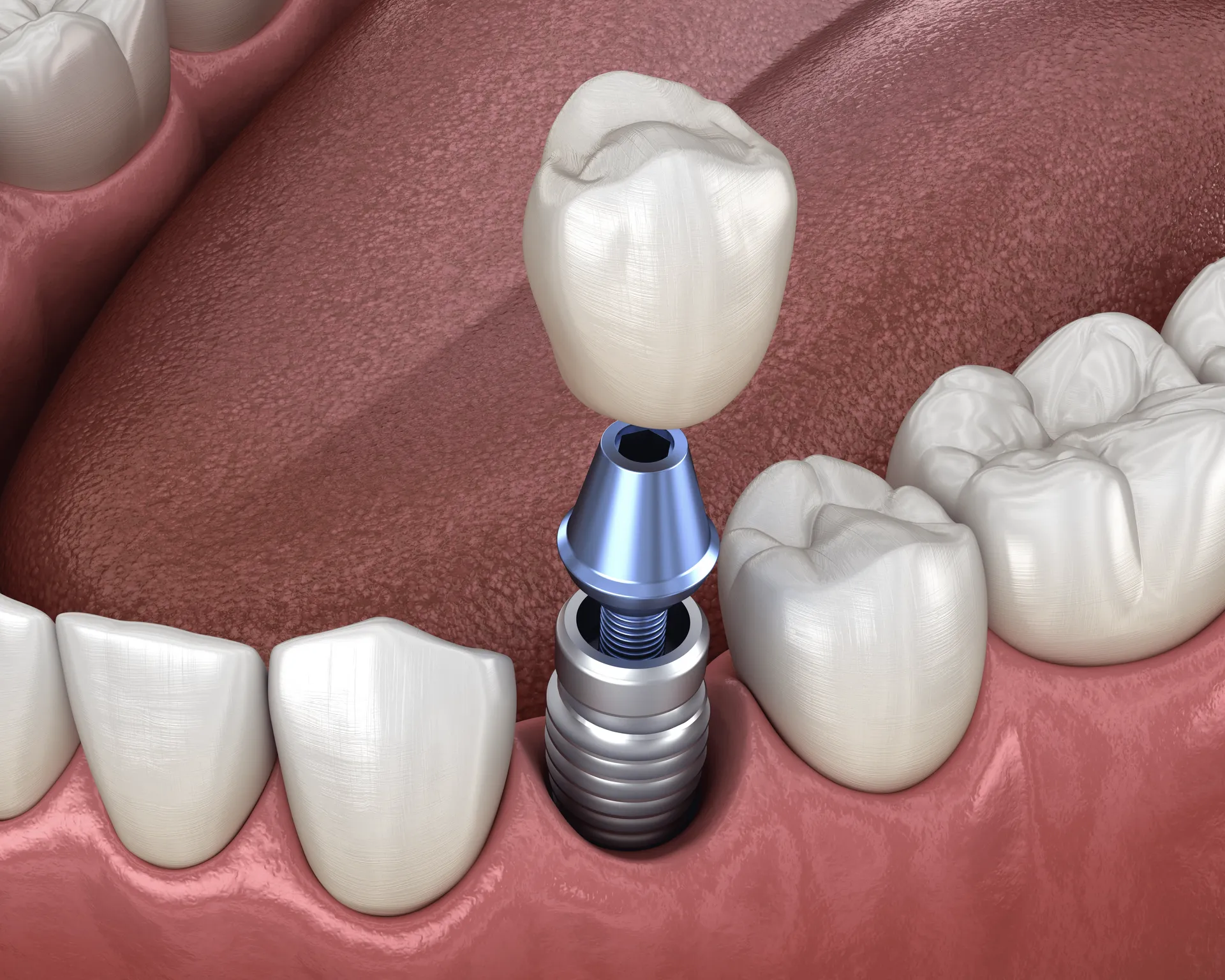 Dental Implants